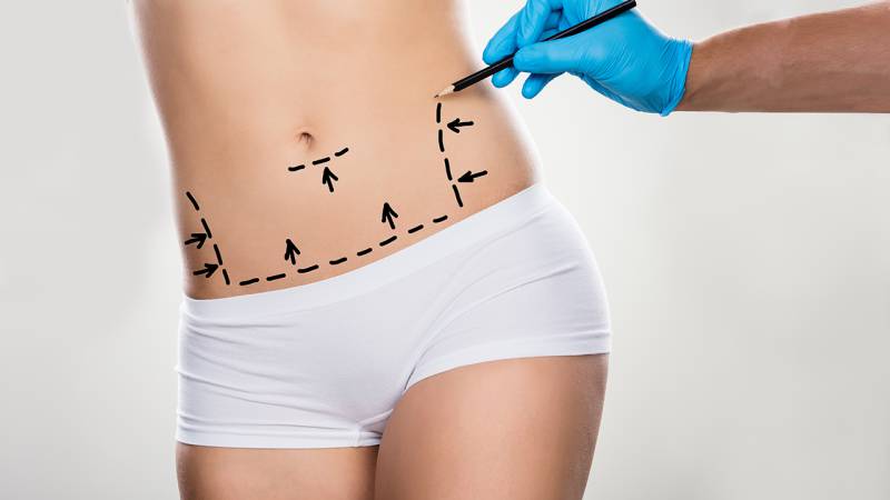 Abdominoplastia