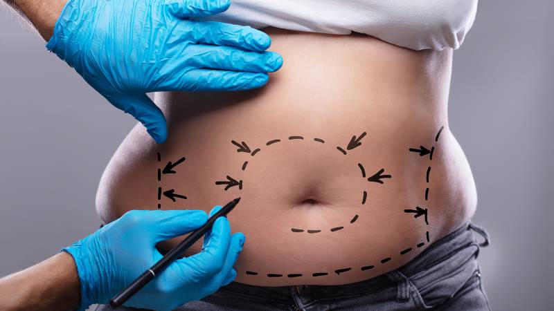 Betaterapia E Abdominoplastia