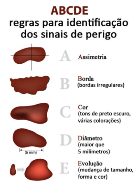 Tipos Cancer Pele